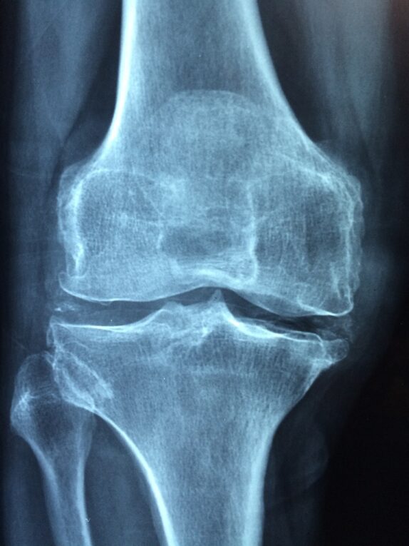 Cartilage - Knee Joint X-Ray